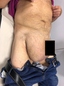 ernia2